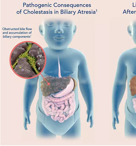 biliary-atresia-infographic