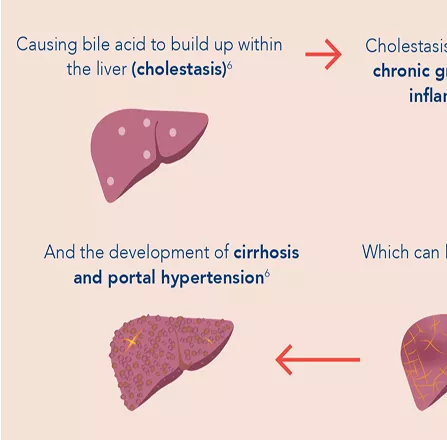 understanding-pbc-infographic